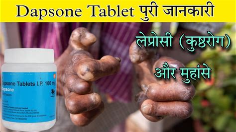 Dapsone Tablet | Uses | Dose | Side effects | Precautions - YouTube