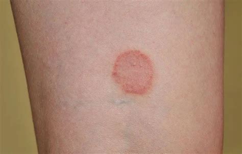 Everything You Need To Know About Ringworm