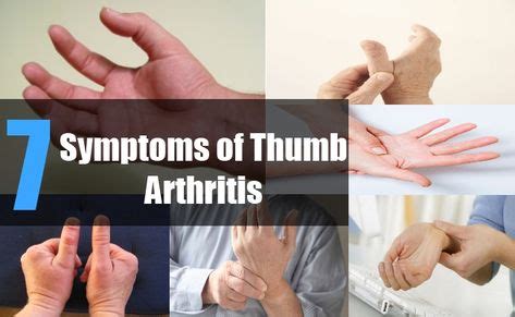 20+ Basal Joint Arthritis ideas in 2020 | arthritis, arthritis symptoms ...