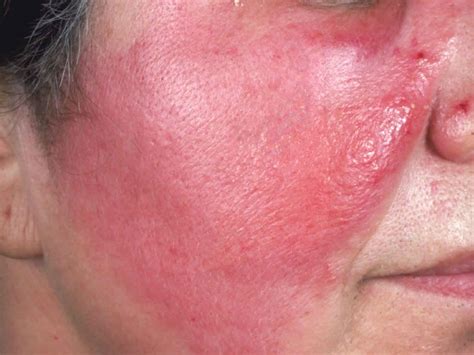 Cellulitis causes, signs, symptoms, diagnosis, prevention and treatment