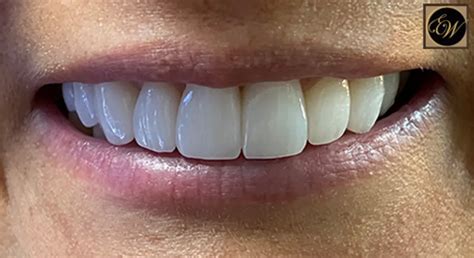 Cosmetic Dentistry Before & After Photos - Rock Hill Dentist: Cosmetic ...