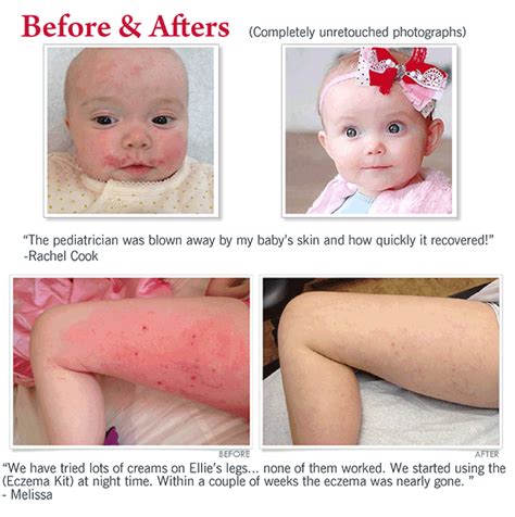 Eczema Experts Hydrocortisone Barrier Cream – Cheryl Lee MD Sensitive ...