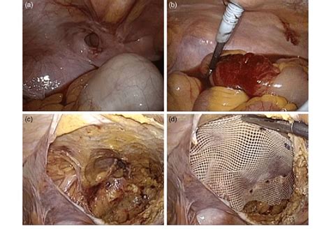 (a) Intraoperative photograph showing the hernia sac surrounded by a ...