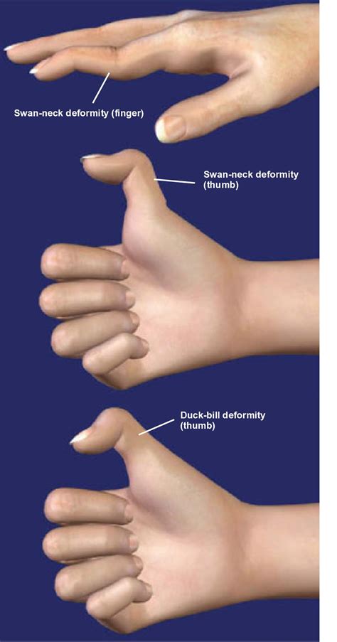 Thumb Extension Deformity