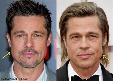 Brad Pitt Plastic Surgery Comparison Photos