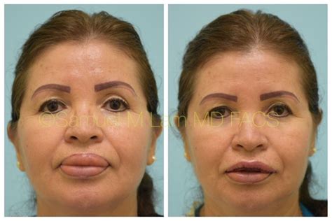 This Hispanic woman is shown before and immediately after lip reduction surgery of her upper lip ...