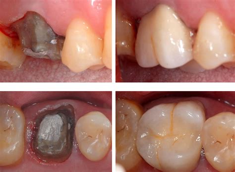 Tooth Crown Before And After