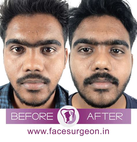 All To Know About Broad Nose Correction Surgery