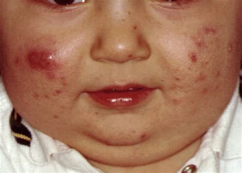 Neonatal Acne