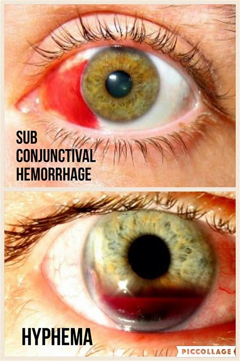 Subconjunctival hemorrhage v. Hyphema #NaturalHomeRemediesForCold in ...