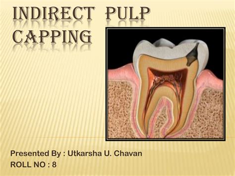 SOLUTION: Indirect pulp capping in dentistry - Studypool