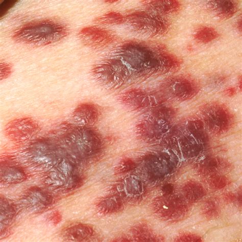 Hiv Related Skin Lesions Kaposi S Sarcoma Part 1 Inte - vrogue.co
