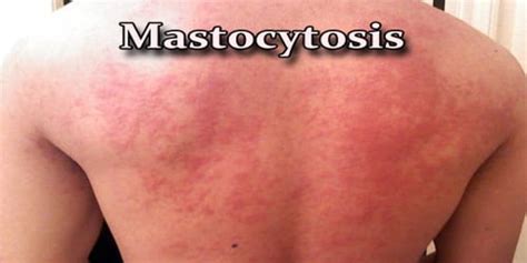 Mastocytosis Causes