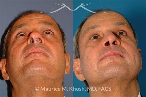 10+ Nasal Valve Collapse Surgery Before And After - SaphireAmmara