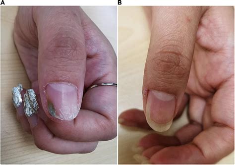 Frontiers | Case report: Novel use of the conventional method- chemical nail avulsion may be ...