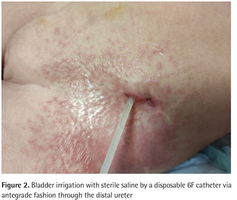 A Rational Solution for Megaureter in Infants with Solitary Kidney: Temporary Loop Cutaneous ...