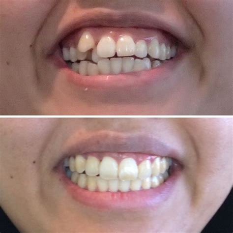 Invisalign Before And After Pictures Reddit | Before And After