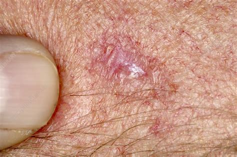 Basal Cell Carcinoma Reddit Pictures - Cancer Rash Skin Cell Basal ...