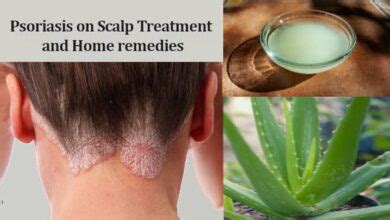 Psoriasis on Scalp Treatment and Home remedies