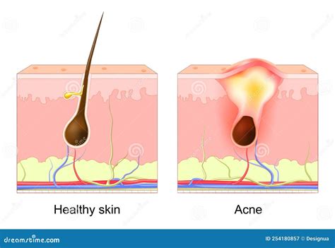 Acne Pimple. Normal Hair Follicle and Clogged Pore Stock Vector ...