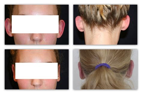 Ear correction before and after photos - Global Care Clinic Belgium