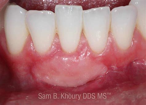 Gum Grafts Before and After - Dr. Sam Khoury