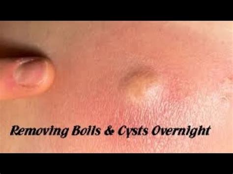 Removing boils & cysts overnight - YouTube