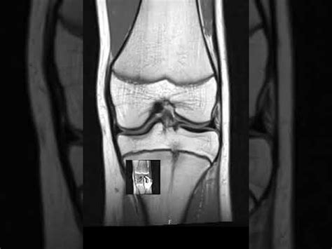 How to Read Knee MRI scan | First Look MRI - YouTube