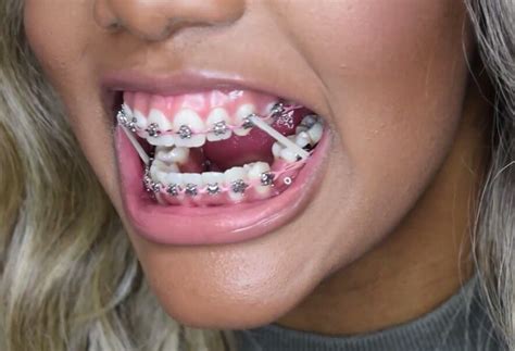 Teeth Braces Cost, Braces Price, Power Chain Braces, Cute Braces Colors, Types Of Braces, Kids ...