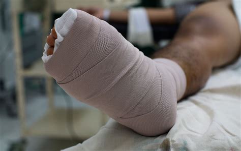 What to Expect After Hallux Rigidus Surgery