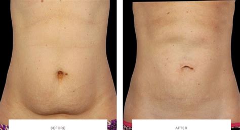 Lose Belly Fat with CoolSculpting London & Bucks | The Cosmetic Skin Clinic