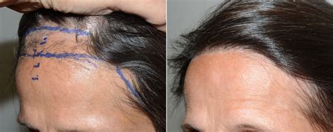 Hairline Advancement, Reparative photos | Miami, FL | Patient120217