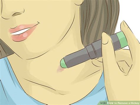 3 Ways to Remove a Hickey - wikiHow