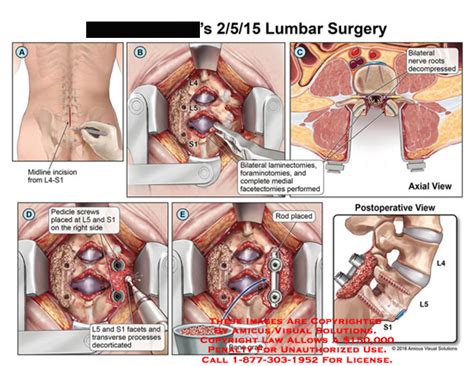 AMICUS Illustration of amicus,surgery,incision,bilateral,laminectomies,foraminotomies,medial ...