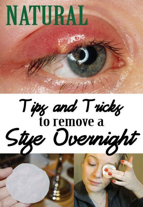 Skin Care Advice That Can Really Help You | Eye stye remedies, Stye remedy, Sty in eye remedies