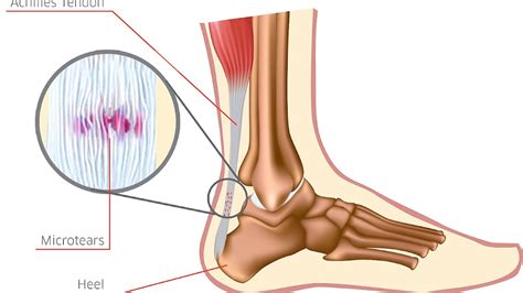 Achilles tendon rupture Injury - Injury Choices