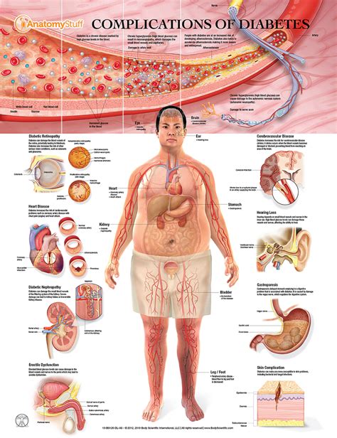 Complications of Diabetes Chart | Organs Diabetes Poster