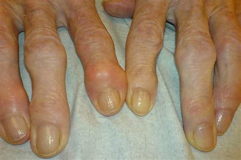 Gout vs Osteoarthritis - Difference and Comparison | Diffen