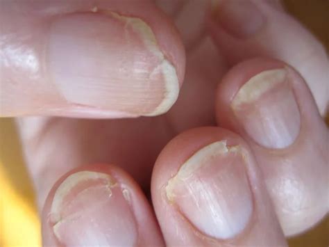 How Your Nails Warn You About Serious Health Conditions - The Health ...