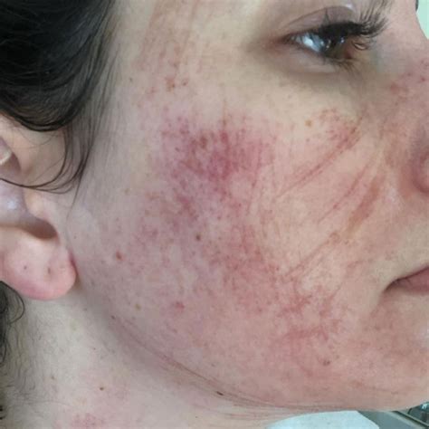 Dermaplaning Gone Wrong - Risks & How to Prevent Them