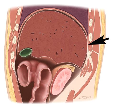 Primary Peritoneal Tumors: Imaging Features with Pathologic Correlation ...