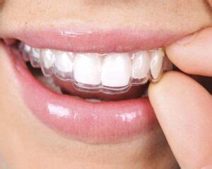 Invisible Braces in South Delhi - Invisible Braces Treatment Costs in Delhi