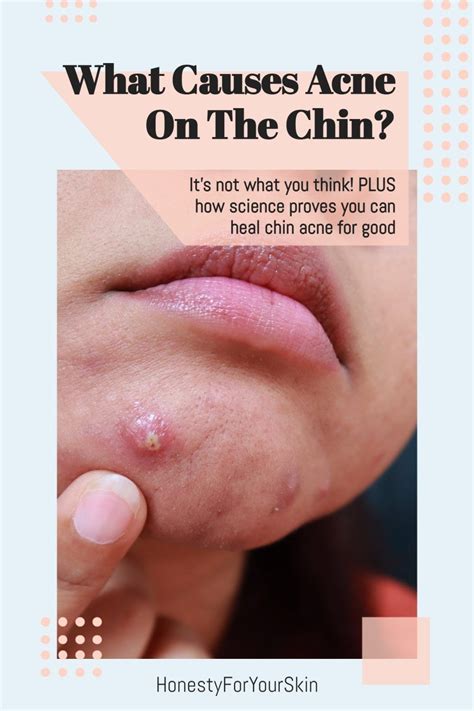 What Causes Acne On The Chin? Plus What to Do About It… | Chin acne treatment, Chin acne causes ...