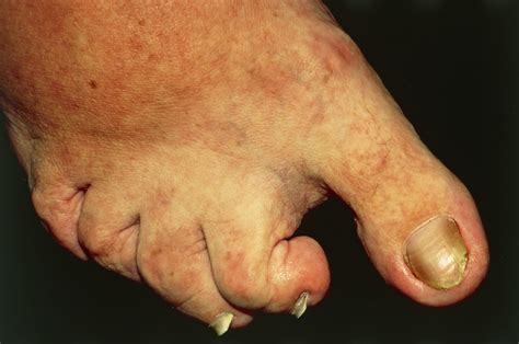 Long-Term Safety and Efficacy of Apremilast for Psoriatic Arthritis - Rheumatology Advisor