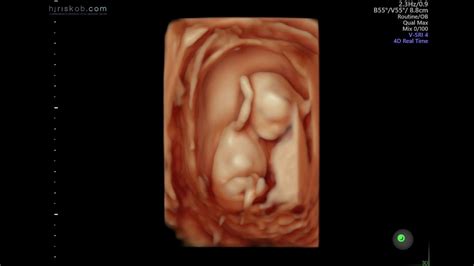 Baby Hallak #3 || 3D 4D Ultrasound at 12 Weeks Pregnant - YouTube