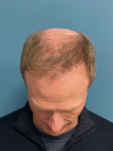 Male Hair Restoration Case 1174 Ann Arbor, MI | Dr. Pramit Malhotra