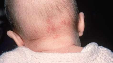 Stork Bite (Nevus Simplex) Birthmark: Angel's Kiss Birthmark Symptoms ...