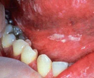 Oral Infection: Overview, Microbiology of Oral Infection, Viral and Fungal Oral Infection