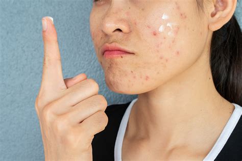 Over-The-Counter Acne Scar Creams: Are They A Bad Investment?