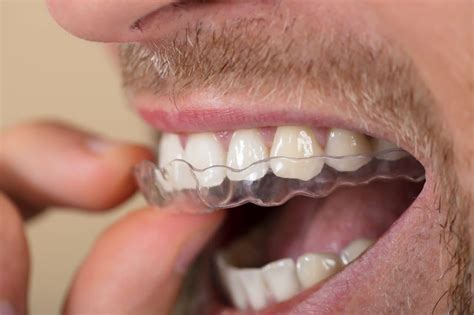 Bruxism Treatment - Bruxism Mouth Gaurd - Greenville, SC